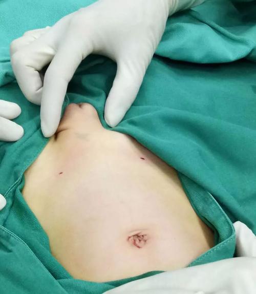 多知道一点儿小儿腹股沟斜疝,是小儿外科最常见的先天性疾病,是指宝宝