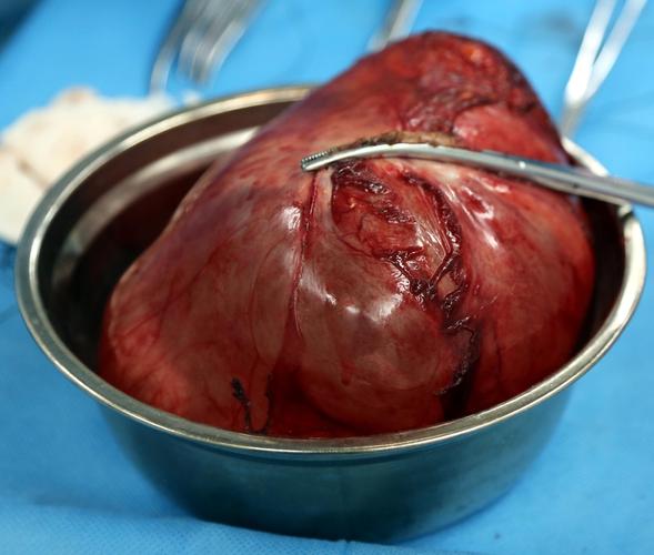 妇产科为一患者摘除一巨大卵巢肿瘤