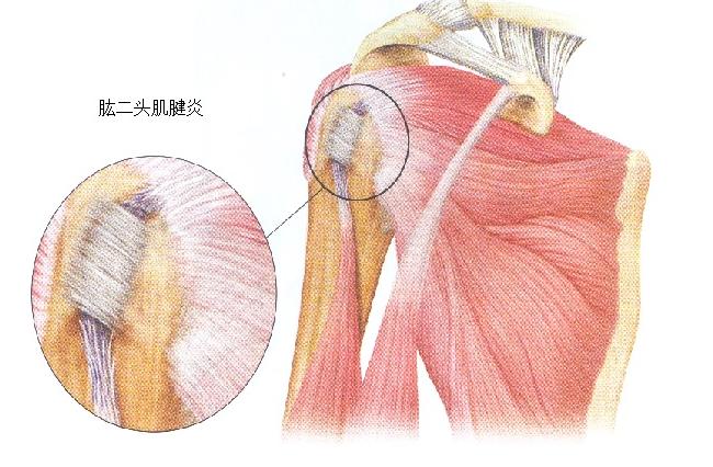 原创超声引导下肱二头肌肌腱炎注射技术