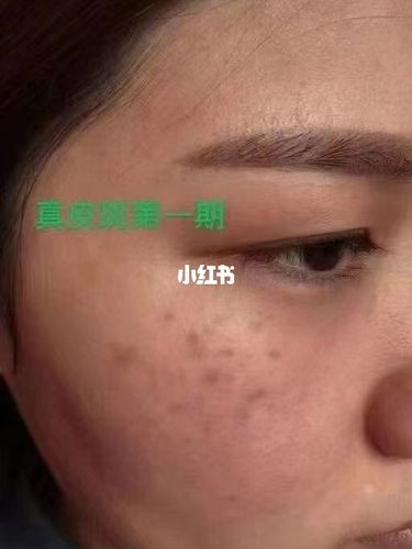 真皮斑又叫"颧骨母斑" 真皮斑最可怕的是初期不重视会