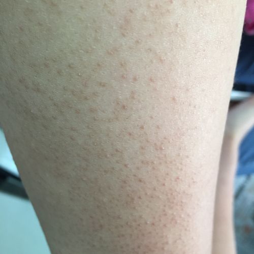 手臂上长了鸡皮肤.请问要怎么才能根治啊?