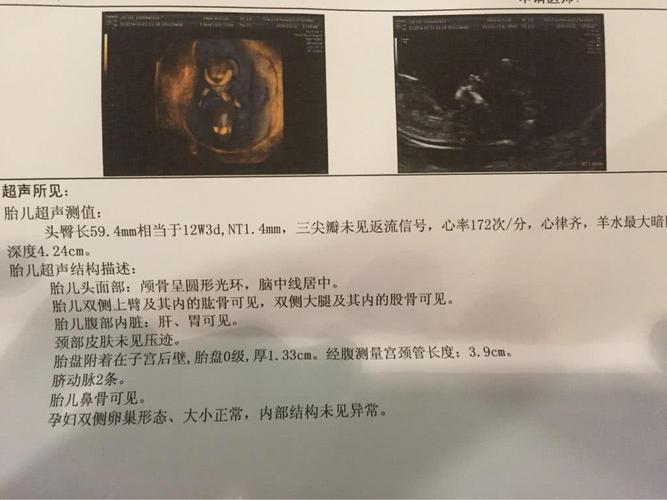 做nt检查前做好这些准备工作,检查会更顺利