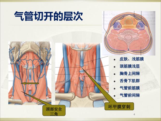 常见的气管切开术.ppt