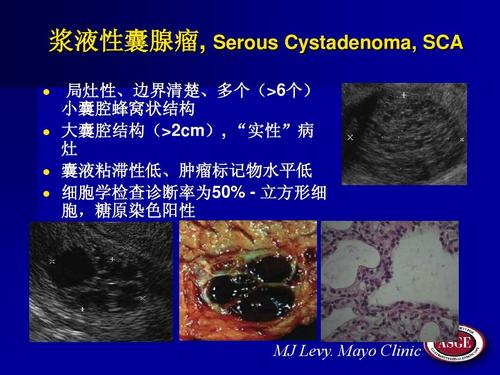 学诊断ppt 上海交通大学瑞金医院消化科 龚  彪,  孙 波 浆液性囊腺瘤
