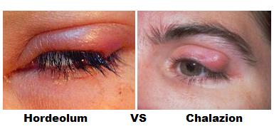  hordeolum purulsnet infnx of one of