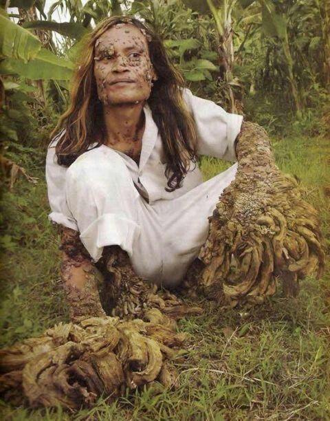 全身被树质包围,整个人成了「树人」,原来是一种病毒