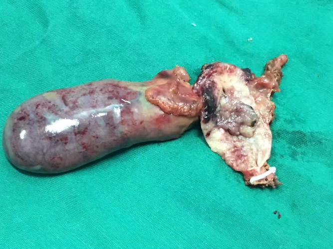 切开后可见腔内菜花样肿瘤,肿瘤对胆管壁外组织无明显侵犯