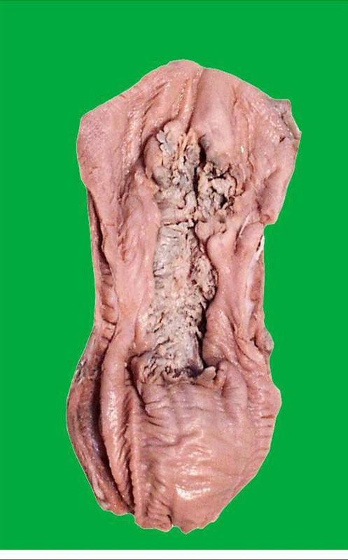 照片名称:髓质型