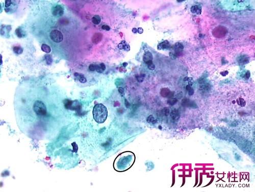 伊秀生活网 健康 / 正文 妇科疾病中,滴虫性阴道炎是不常见的一种妇科