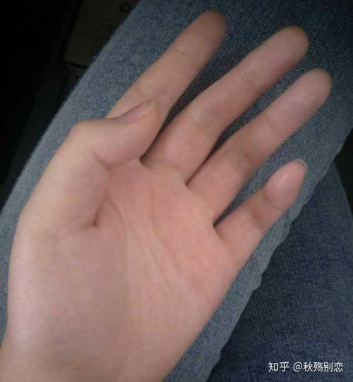 的小哥哥小姐姐,我的情况是从小就有的,我家里是我爸爸有手出汗的情况