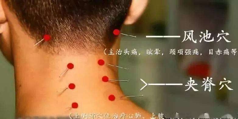 中医治疗颈椎病大全,全是干货,速收藏