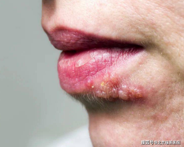 出现唇疱疹,啥药管用?