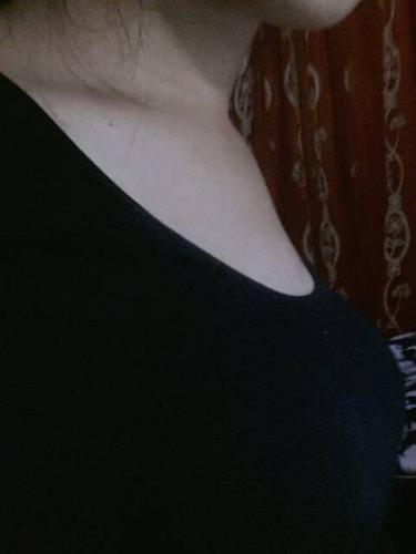 锁骨那片骨头有点畸形,怎么回事?本人16岁,该怎么恢复