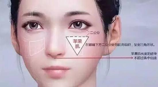 自体脂肪面部填充 想年轻?苹果肌很重要