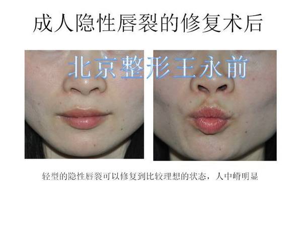 隐性唇裂需要修复吗?