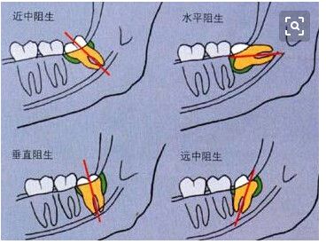 这些智齿不拔掉,会有哪些危害?1.