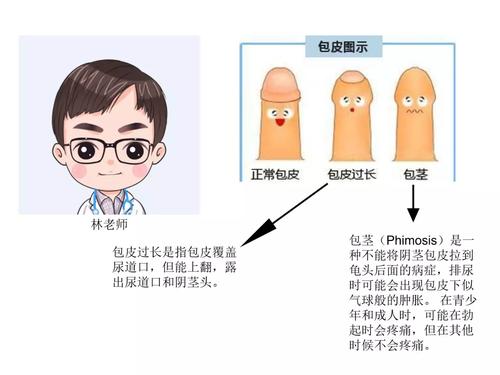 暴走漫画之包皮过长和包茎到底有多可怕