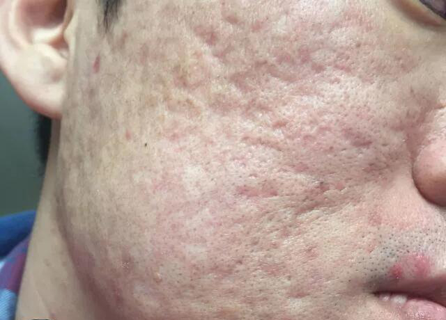 痘坑痘印能治疗好吗?靳医生告诉你痘坑的治疗真相!