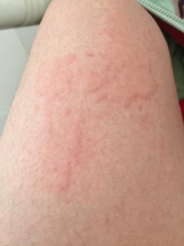 大腿上都是一大片的红疙瘩,很久都没有散退,很担心是白血病的前兆