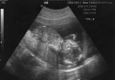 b超检查给告知是男孩,结果宝宝出生后下身却长着三个小东东