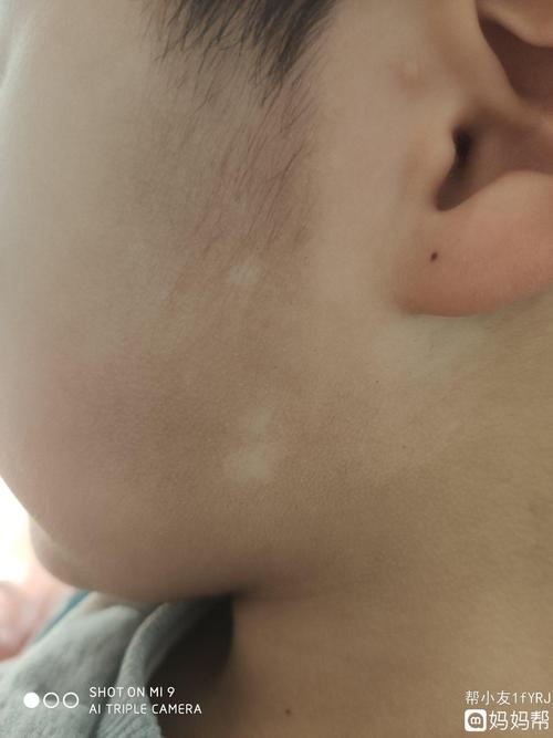 孩子脸上起了白斑是怎么回事有宝妈知道