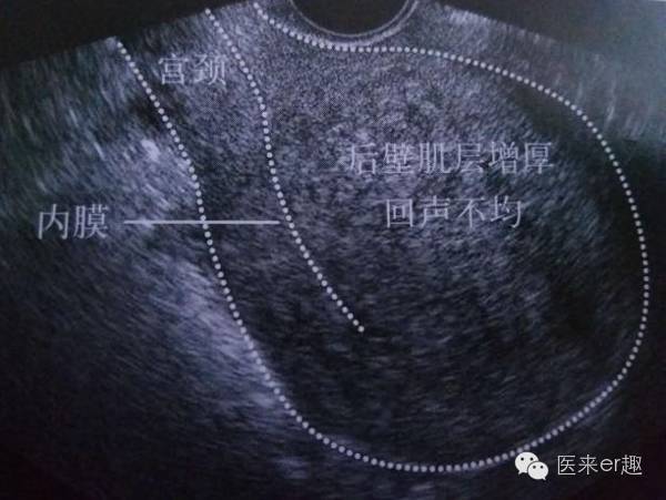 ②,子宫宫腺肌瘤,腺肌症:a.子宫腺肌瘤时子宫呈均匀性增大 b.
