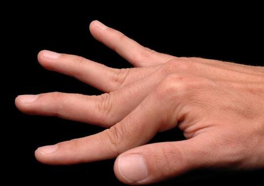 郑州痛风病专科医院专家讲述手指关节痛的常见原因