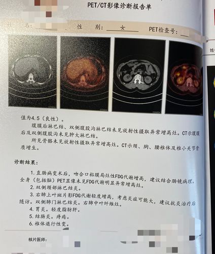 直肠病变petct检查案例-上海petct/mr检查预约