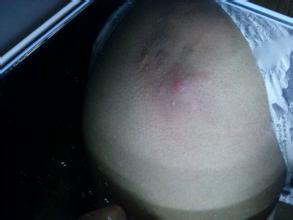 疖子是什么 疖子的临床表现