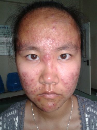 面部散在黄豆大椭圆形囊肿,颜色暗红,压迫时有血性分泌物排出,伴有