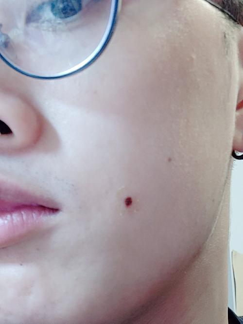 我在右脸有一颗比较大的痣,3mm左右,不过他们觉得