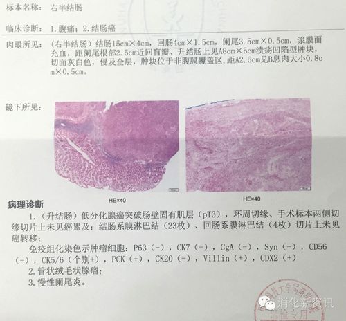 这个简单的结肠癌病例有看点有热点