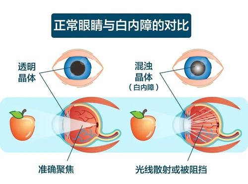 中老年人眼病有哪些?这些都是视力杀手!
