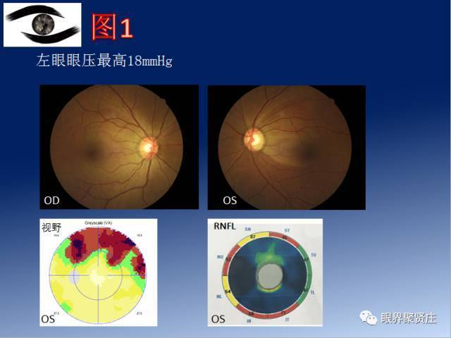 正常眼压性青光眼(ntg) 图中可见,左眼典型的青光眼性视野缺损(上方
