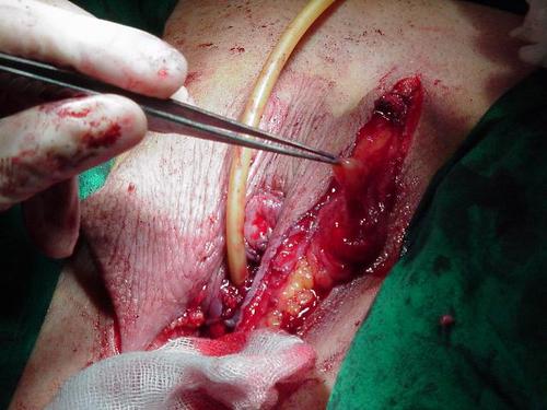 发组变性手术的图片大家看看