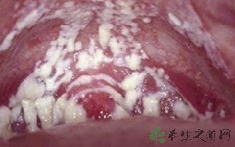 什么叫霉菌性阴道炎