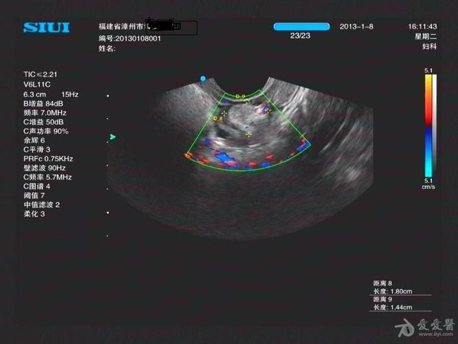 腔内超声:典型双子宫,双宫颈
