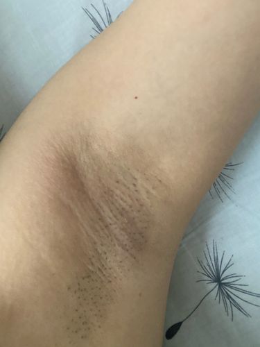 毛抬手臂腋窝是鼓起图片腋窝毛假体隆胸腋下切口图片胳膊腋窝图片,长