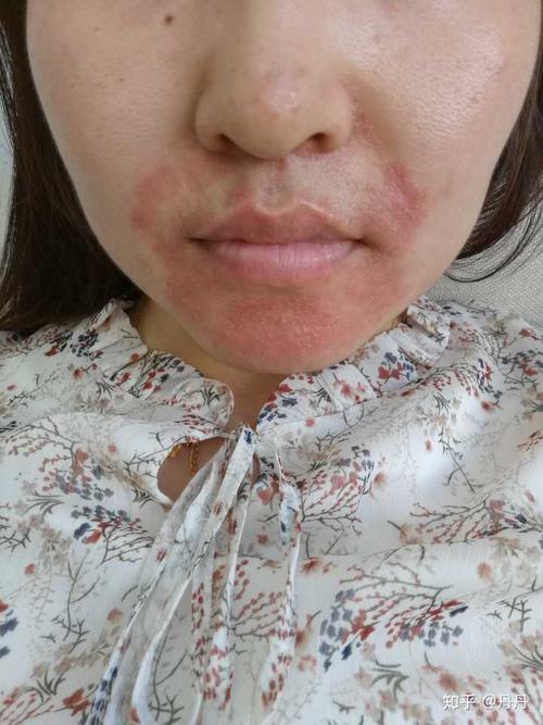 如何治疗面部脂溢性皮炎,困扰我n年了,求各位大神给我