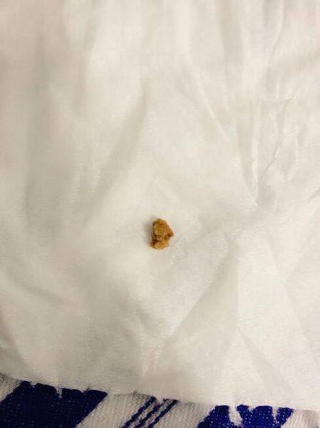 用力一模是粉状,这是肾结石取出来的石头,请问这是草酸钙结石还是磷酸