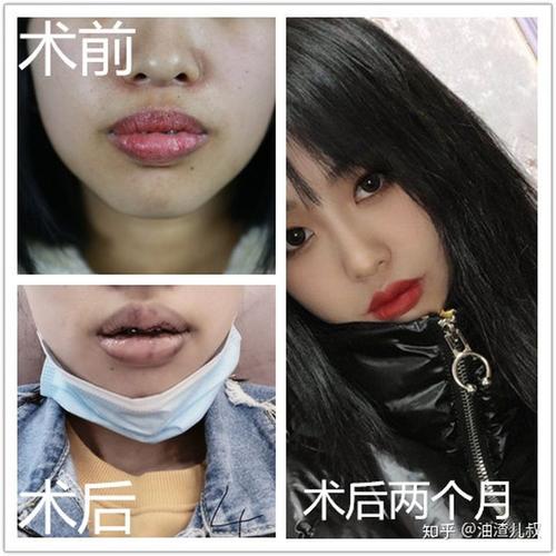怎么把厚唇变薄?