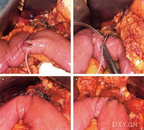 胰十二指肠切除术