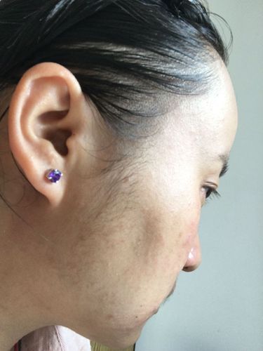 女性脸颊两侧长了很多毛有点像落腮胡怎么办?