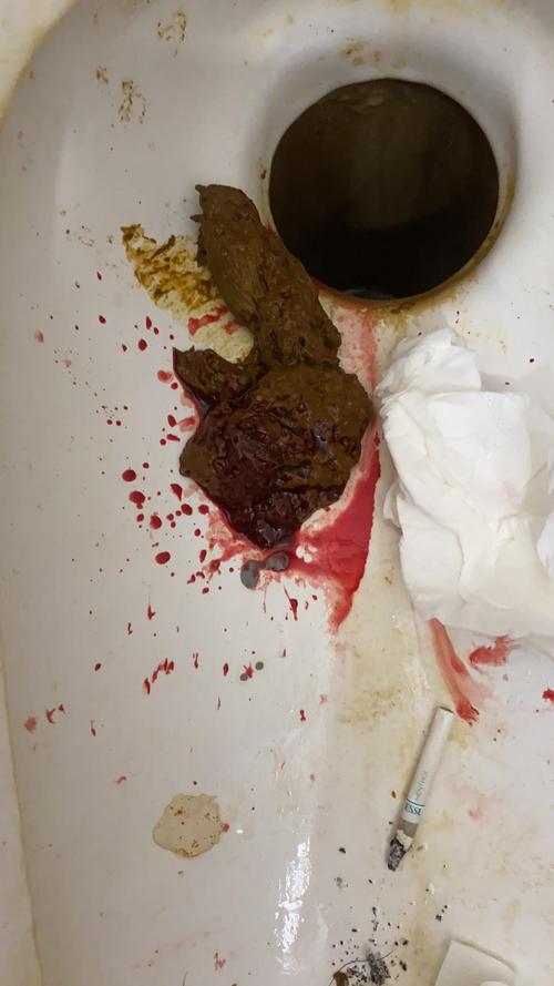 大便出血有痔疮不知道是外痔还是内痔