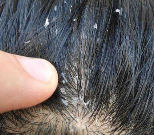 头皮屑大块掉极有可能长了一种癣治癣2秘方杀菌就能好