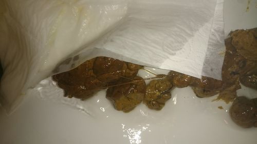 请问大便里这条状物是什么?
