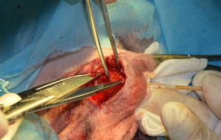 [转载]外科根治顽固性肛门腺炎