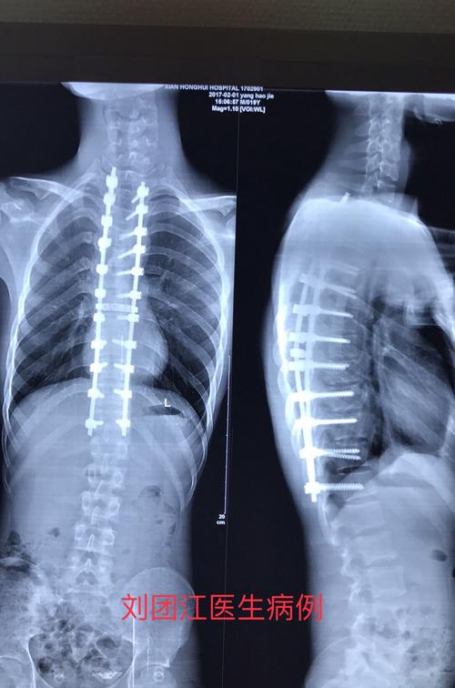 19岁的脊柱侧弯,还要手术吗?