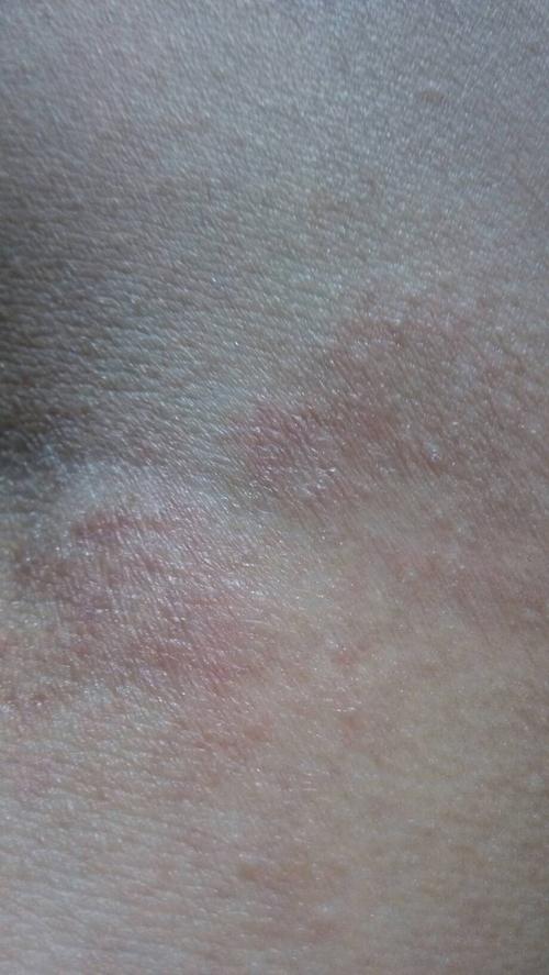 问:这是皮癣吗?非常痒～怎么治疗,如果不是的话, 是长了什么东西?