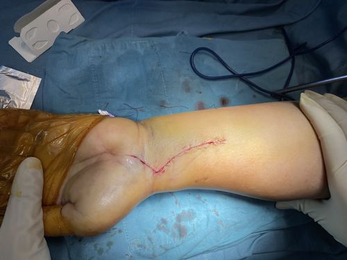 扩大fcr入路治疗复杂桡骨远端骨折